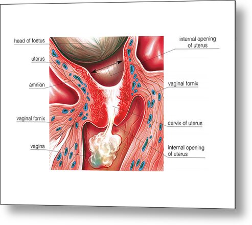 Anatomy Metal Print featuring the photograph Cervix In Pregnancy #1 by Asklepios Medical Atlas