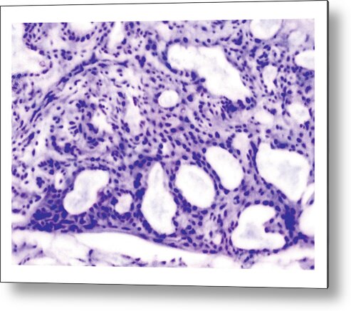 Anatomy Metal Print featuring the photograph Lactating Breast Tissue #1 by Asklepios Medical Atlas