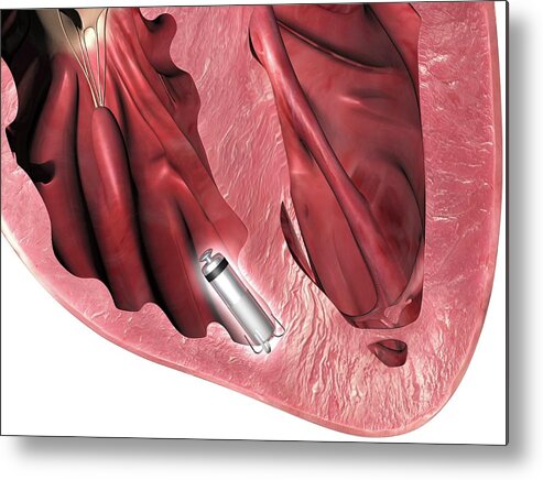 Anterior Cut Metal Print featuring the photograph Leadless Pacemaker In Anterior Heart #6 by Alfred Pasieka