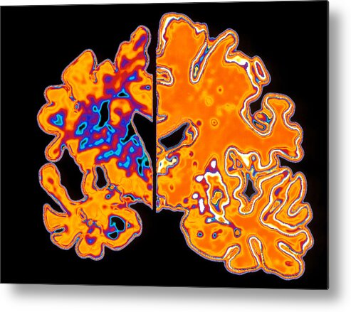 Alzheimer's Disease Metal Print featuring the photograph Artwork Of Alzheimer's Diseased Brain Vs Normal by Pasieka