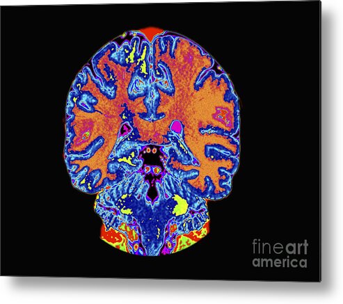 Mri Metal Print featuring the photograph Coronal View Mri Of Normal Brain by Medical Body Scans