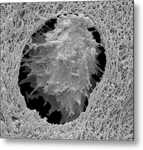 Human Tissue Metal Print featuring the photograph Bone Cancer Cell #1 by Steve Gschmeissner/science Photo Library