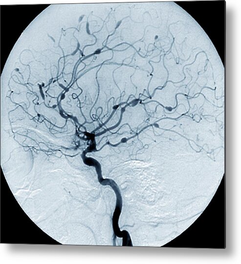 Carotid Angiogram Metal Print featuring the photograph Cerebral Aneurysms In Lupus by Zephyr/science Photo Library