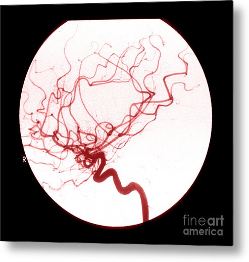 Cerebral Angiogram Metal Print featuring the photograph Internal Carotid Cerebral Angiogram #2 by Medical Body Scans