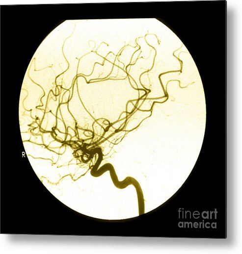 Cerebral Angiogram Metal Print featuring the photograph Internal Carotid Cerebral Angiogram by Medical Body Scans