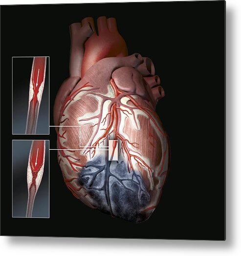Atherosclerosis Metal Print featuring the photograph Heart Ischaemia by Henning Dalhoff