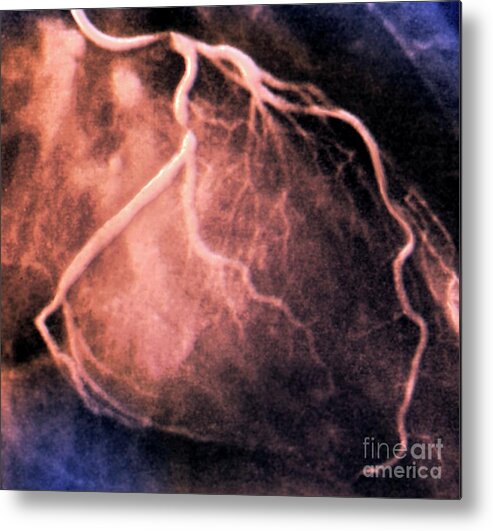 Coronary Artery Stenosis Metal Print featuring the photograph Coronary Artery Stenosis #2 by Zephyr/science Photo Library