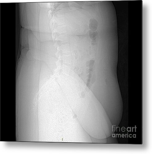 Science Metal Print featuring the photograph X-ray Of Morbidly Obese Patient #1 by Living Art Enterprises