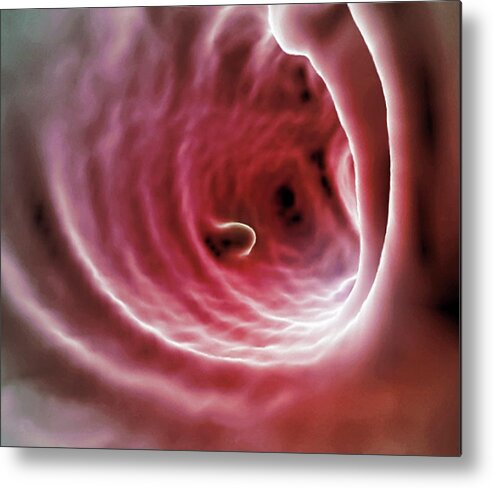 3d Metal Print featuring the photograph Intestinal Polyp #2 by Zephyr/science Photo Library