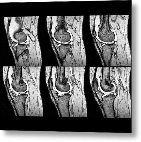 Human Metal Print featuring the photograph Knee Sprain #2 by Zephyr