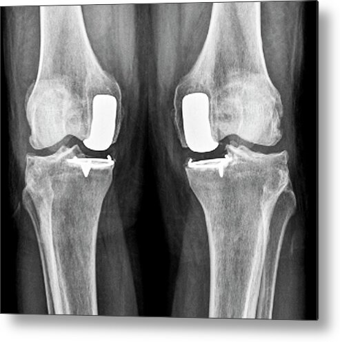 Nobody Metal Print featuring the photograph Partial Knee Replacement #5 by Zephyr