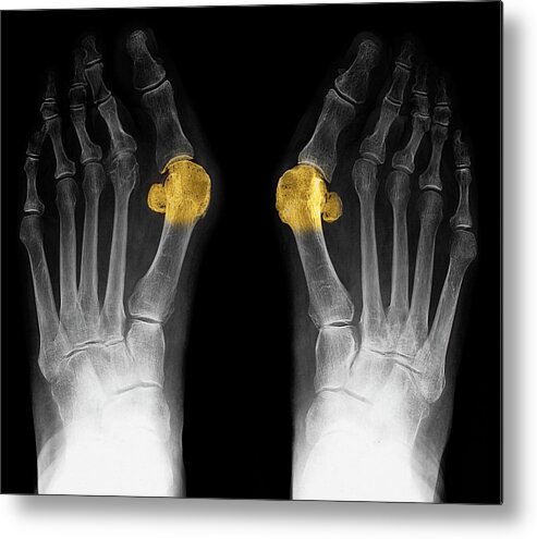 Hallux Valgus Metal Print featuring the photograph Bunions by Zephyr/science Photo Library