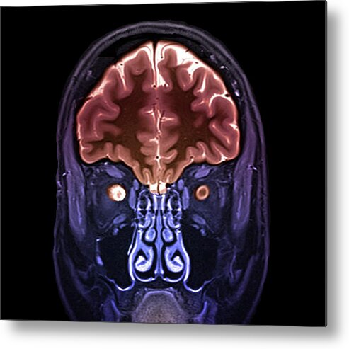 Multiple Sclerosis Metal Print featuring the photograph Optic Nerve Multiple Sclerosis Symptom by Zephyr/science Photo Library