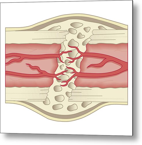 Cross Section Biomedical Illustration Of Bone Repairing Itself With New Soft Spongy Callus Developing On Framework Provided By Fibrous Tissue Joining The Broken Ends Metal Print By Dorling Kindersley