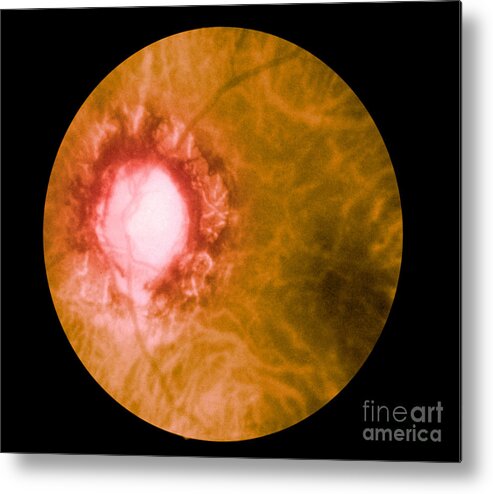 Bacteria Metal Print featuring the photograph Retina Infected By Syphilis by Science Source