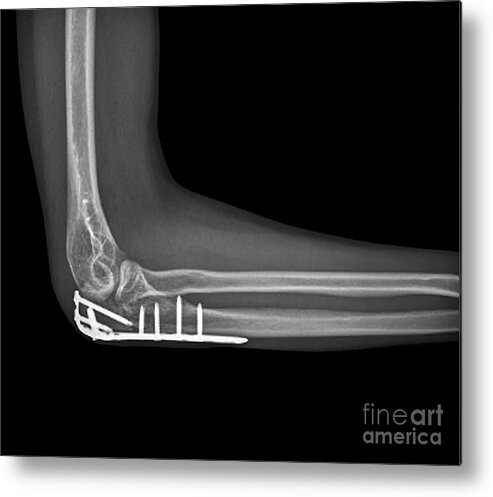 Patient Metal Print featuring the photograph Fixed Elbow Fracture #2 by Zephyr/science Photo Library