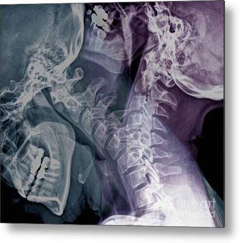 Anatomical Metal Print featuring the photograph Flexion Of The Cervical Spine by Zephyr/science Photo Library