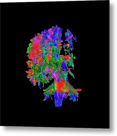 Cerebral Palsy Metal Print featuring the photograph Cerebral Palsy #1 by Simon Fraser/science Photo Library