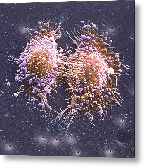 Disease Metal Print featuring the photograph Cancer Cell Division #10 by Steve Gschmeissner