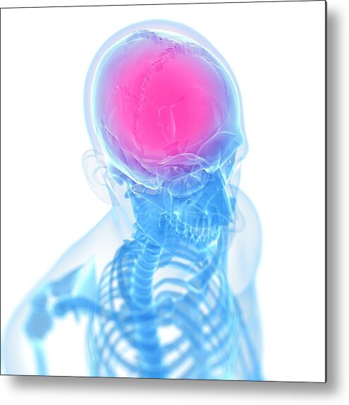 Anatomy Metal Print featuring the photograph Headache #62 by Sciepro/science Photo Library