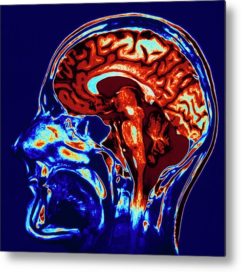 People Person Persons Metal Print featuring the photograph Coloured Mri Scan Of Brain In Sagittal Se by Geoff Tompkinson