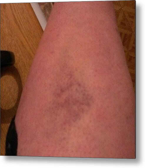 Rollerderby Metal Print featuring the photograph #derby #bruise Finally Coming Out by Bee Mcmahon