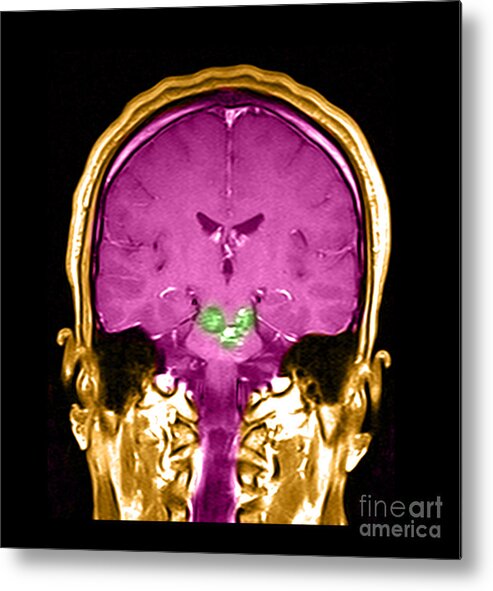 Anatomical Metal Print featuring the photograph Mri Brainstem Cavernous Malformations #1 by Medical Body Scans