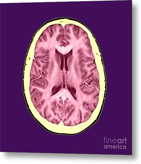 Anatomical Metal Print featuring the photograph Normal Cross Sectional Mri Of The Brain #3 by Medical Body Scans