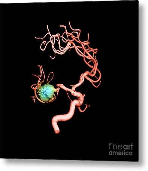 3-d Imagery Metal Print featuring the photograph Aneurysm In The Human Brain #3 by Medical Body Scans
