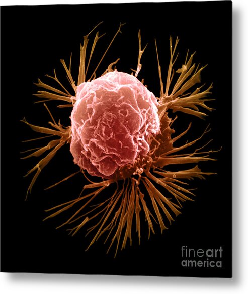 Sem Metal Print featuring the photograph Breast Cancer Cell #6 by Science Source