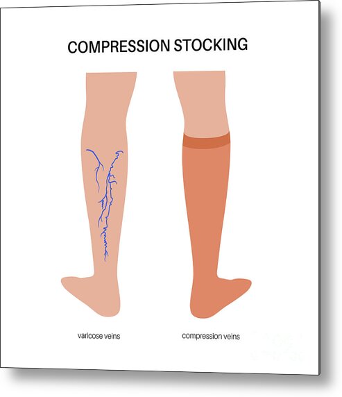 Compression Stockings For Varicose Veins Metal Print by Pikovit