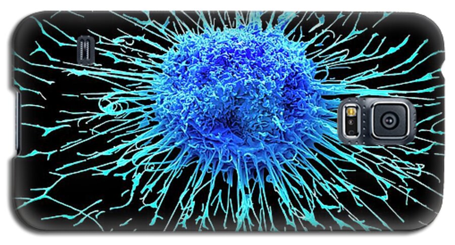 Adenocarcinoma Galaxy S5 Case featuring the photograph Lung Cancer Cell #10 by Steve Gschmeissner/science Photo Library