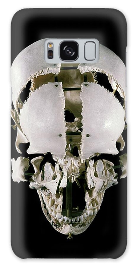 Human Galaxy Case featuring the photograph 19th Century Beauchene 'exploded' Skull by Patrick Landmann/science Photo Library
