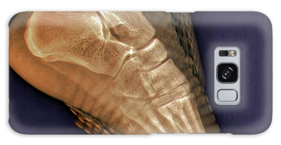 Radiography Galaxy Case featuring the photograph Healthy Ankle Joint #1 by Zephyr/science Photo Library