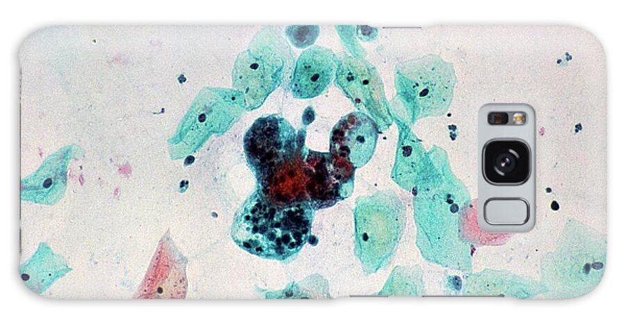 Adenocarcinoma Galaxy Case featuring the photograph Lm Of Cervical Smear Showing Adenocarcinoma #1 by Science Photo Library