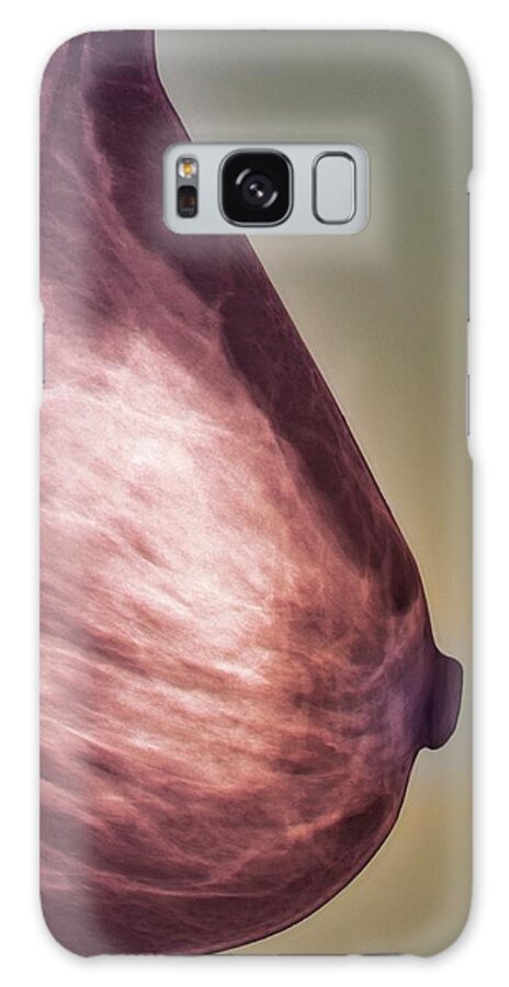 Radiography Galaxy Case featuring the photograph Normal Mammogram #1 by Zephyr/science Photo Library