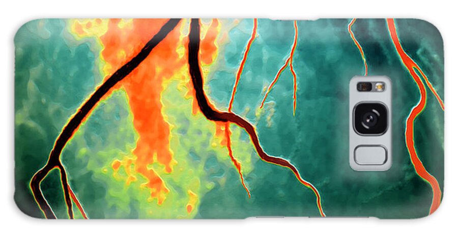 Blood Vessel Galaxy Case featuring the photograph Narrowed Coronary Artery #2 by Zephyr/science Photo Library