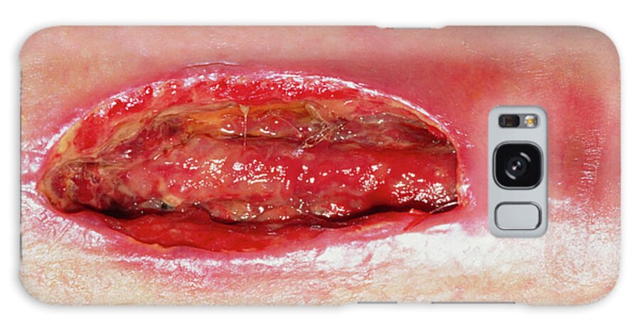 Wound Galaxy Case featuring the photograph Close Up Of An Open And Infected Leg Wound by Garry Watson/science Photo Library