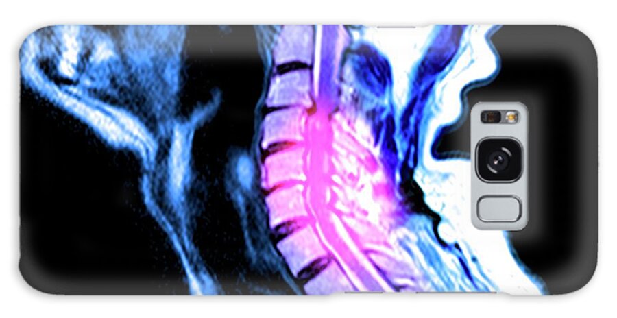 Disease Galaxy Case featuring the photograph Compressed Spinal Cord by Du Cane Medical Imaging Ltd