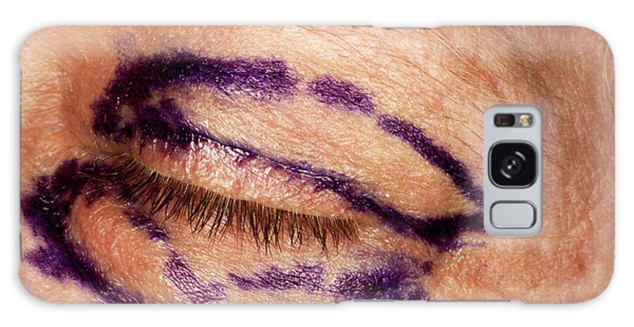 Mark Galaxy Case featuring the photograph Cosmetic Eyelid Surgery by Mauro Fermariello/science Photo Library