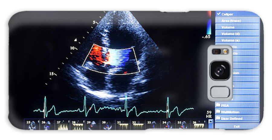 Test Galaxy Case featuring the photograph Doppler Echocardiography Scan by Aberration Films Ltd