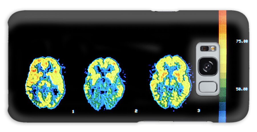 Brain Galaxy Case featuring the photograph Drug Treatment Of Aids Dementia by National Cancer Institute/science Photo Library