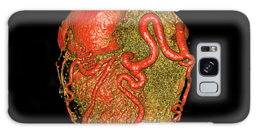 Heart Galaxy Case featuring the photograph Enlarged Coronary Arteries by Antoine Rosset/science Photo Library