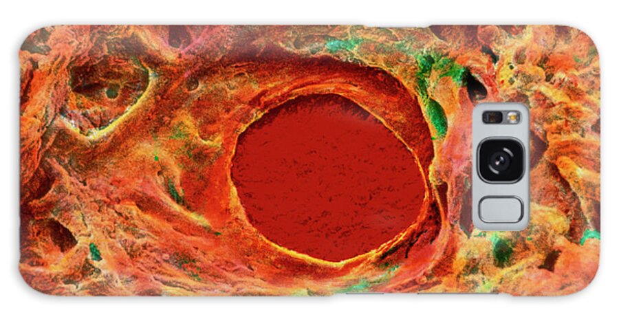 Ulcer Galaxy Case featuring the photograph Gastric Ulcer by Prof. J. James/science Photo Library