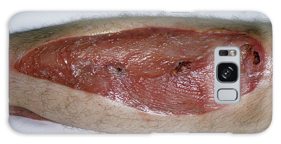 Skin Graft Galaxy Case featuring the photograph Leg Skin Graft by Mike Devlin/science Photo Library