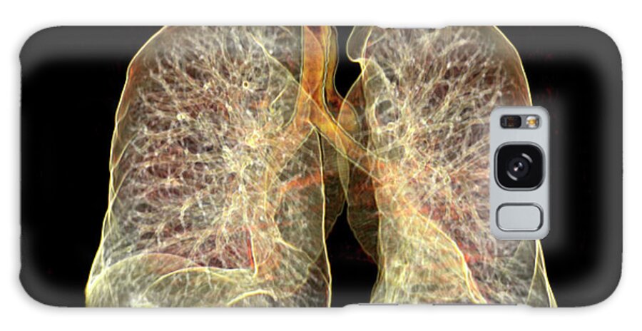 Lungs Galaxy Case featuring the photograph Lungs by Antoine Rosset/science Photo Library