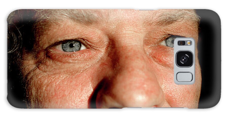 Human Galaxy Case featuring the photograph Man Before Cosmetic Eyelid Surgery by Mauro Fermariello/science Photo Library