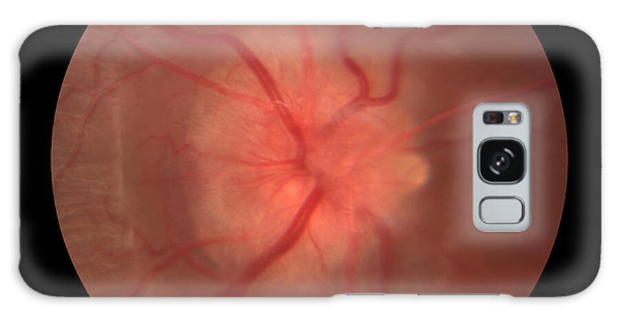 Abnormal Galaxy Case featuring the photograph Optic Neuritis With Drusen by Paul Whitten