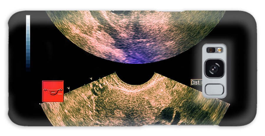 Cyst Galaxy Case featuring the photograph Ovarian Cysts by Zephyr/science Photo Library