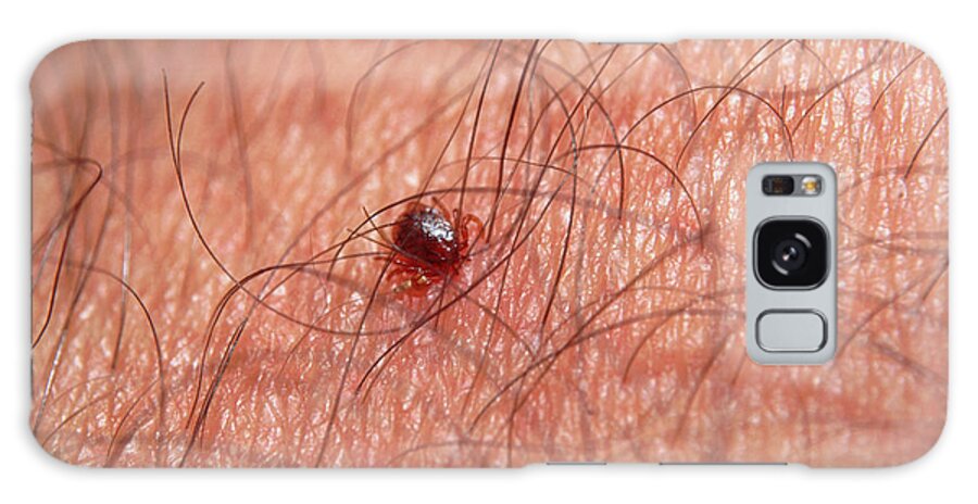 Tick Galaxy Case featuring the photograph Tick Feeding On Human Skin by Sinclair Stammers/science Photo Library